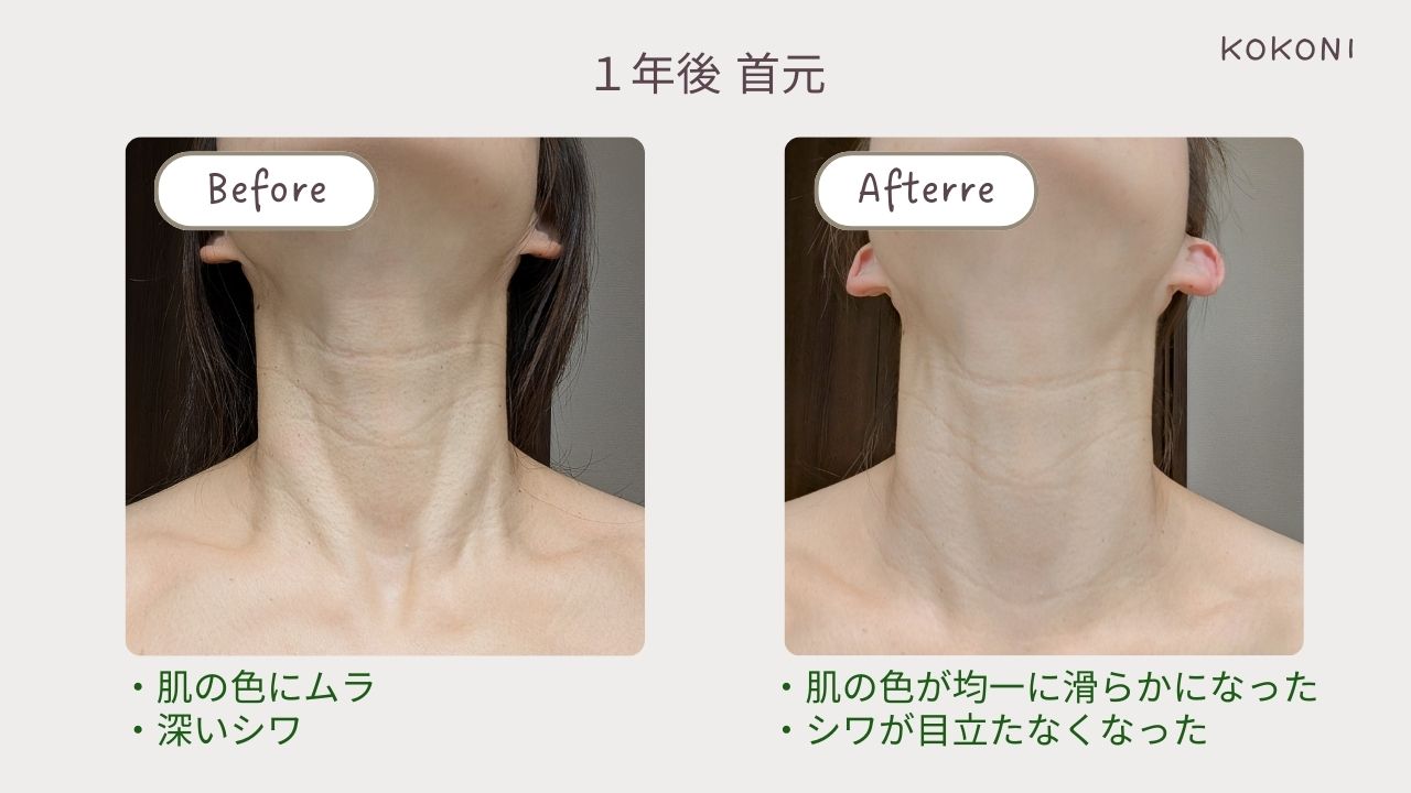 写真あり】ケノンでシミ取りは本当にできる？1年経過レポと危険なNG 
