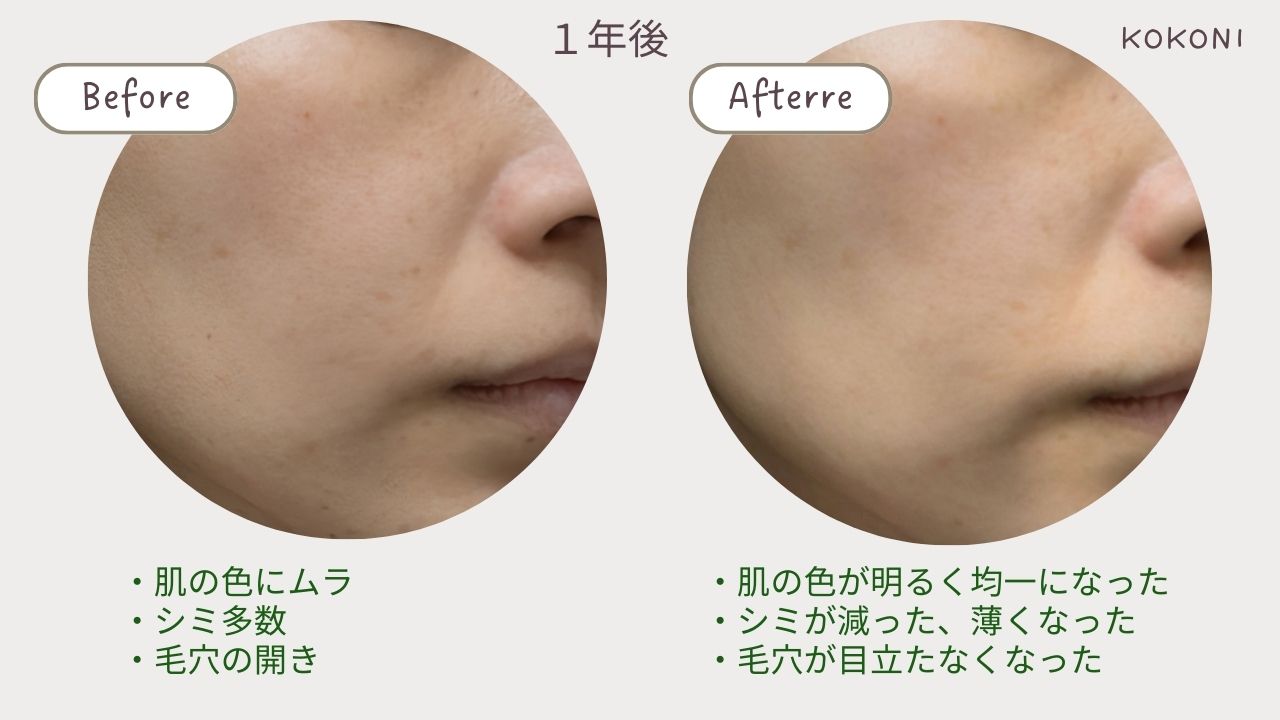 脱毛ケノン （ケノン」と「リファ」の違いを比較！どっちがおすすめ？ | 美容比較.com）