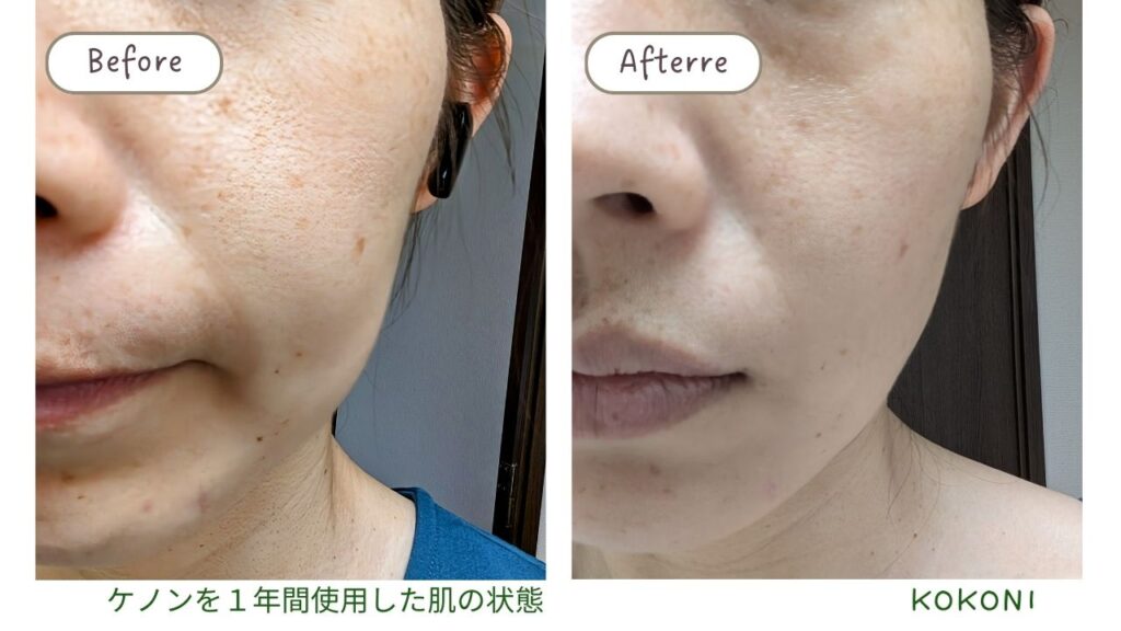 家庭用脱毛器「ケノン」の効果は？顔のシミやほくろには効くの？頻度は 